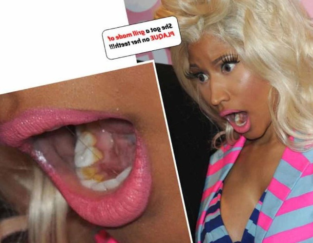 Nicki Minaj Teeth  nude photo