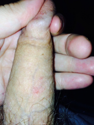 Latex Condom Allergic Reaction Penis  nude photo