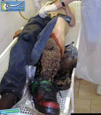 Man With Maggots In Leg  nude photo